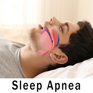 Diagram of man with narrowed airway with sleep apnea