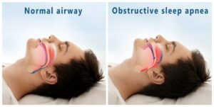 Normal airway comparison to sleep apnea airway